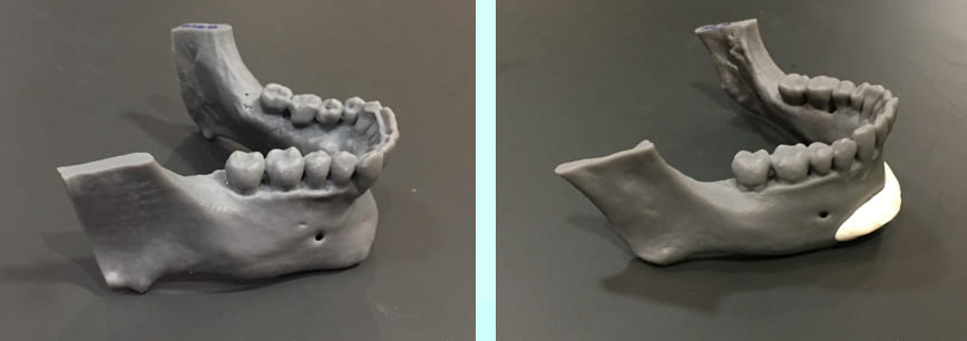 impresión en 3D de la mandíbula 