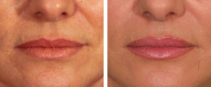 Operación de labios con tejido fibrograso facial -SMAS-