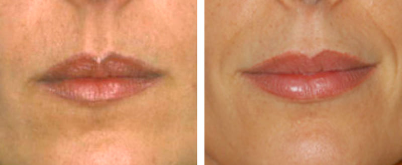 Queiloplastia-aumento labial con plastia WPL