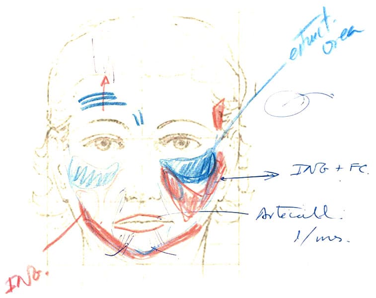 Lipoinjerto facial femenino diagnostico