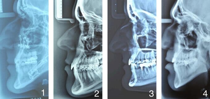  Hipermentonismo, que tienen un mentón grande; o Prognatismo, cuando su mandíbula es prominente,