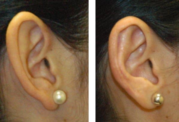 Corrección de abano, Reducción del pabellón auricular​