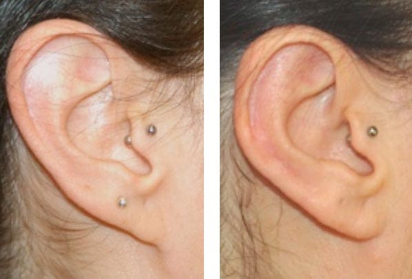 Reducción del pabellón auricular, Reducción del lóbulo​ (fauno)​