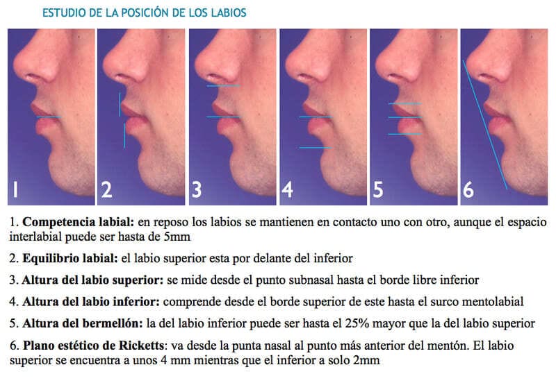 Queiloplastia-estudio-posicion-labios